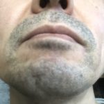 ケノンでヒゲ脱毛